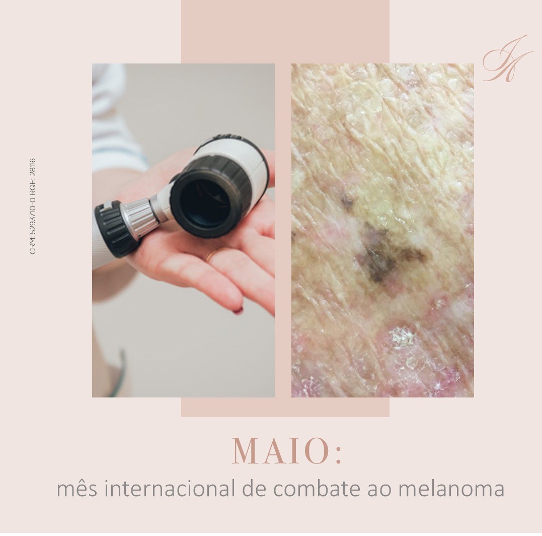 Você está visualizando atualmente Mês internacional de combate ao melanoma!