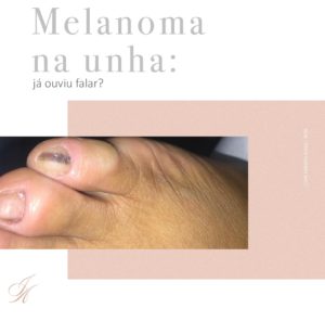 Leia mais sobre o artigo Melanoma na unha: o que fazer?