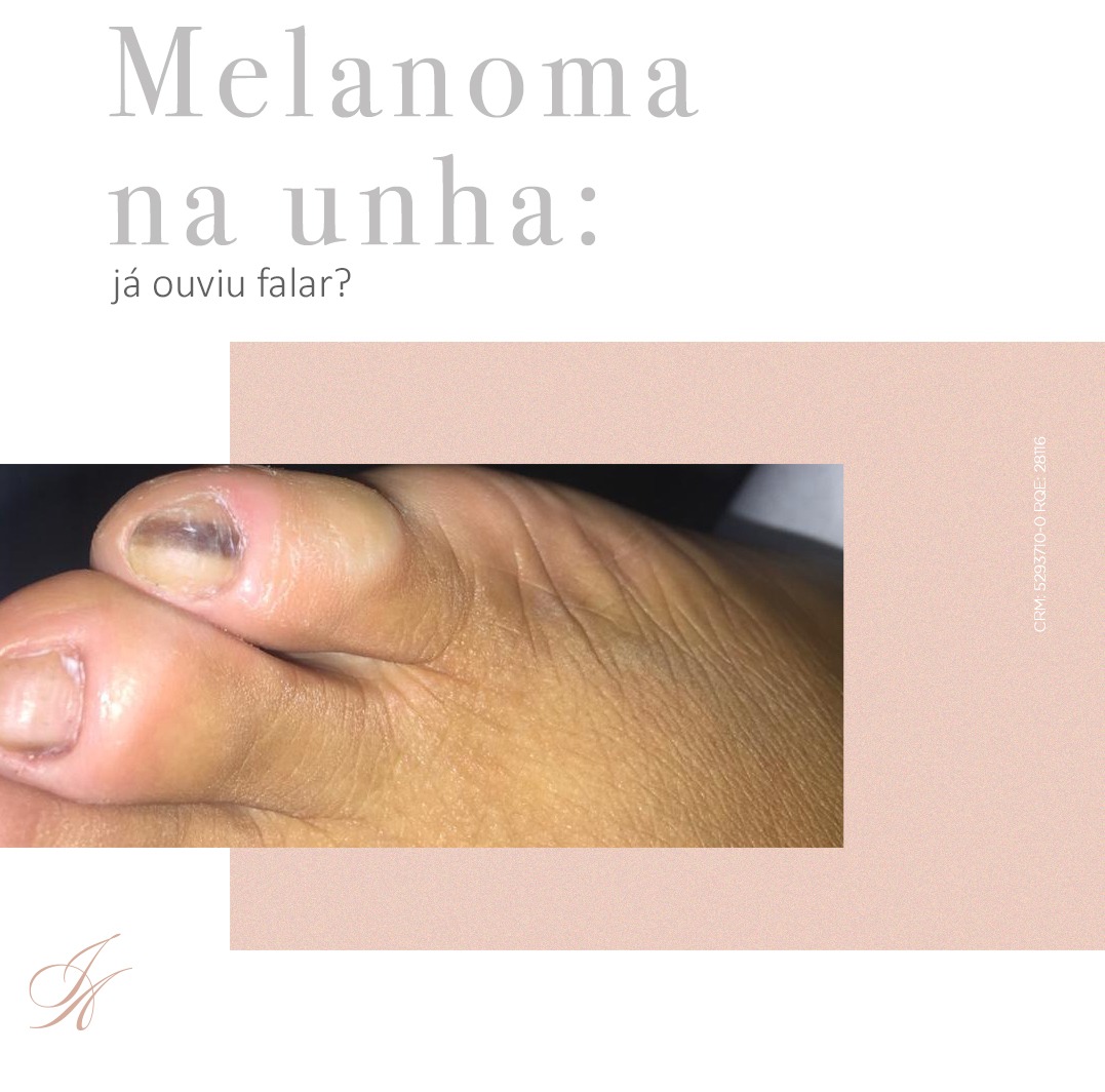 Você está visualizando atualmente Melanoma na unha: o que fazer?