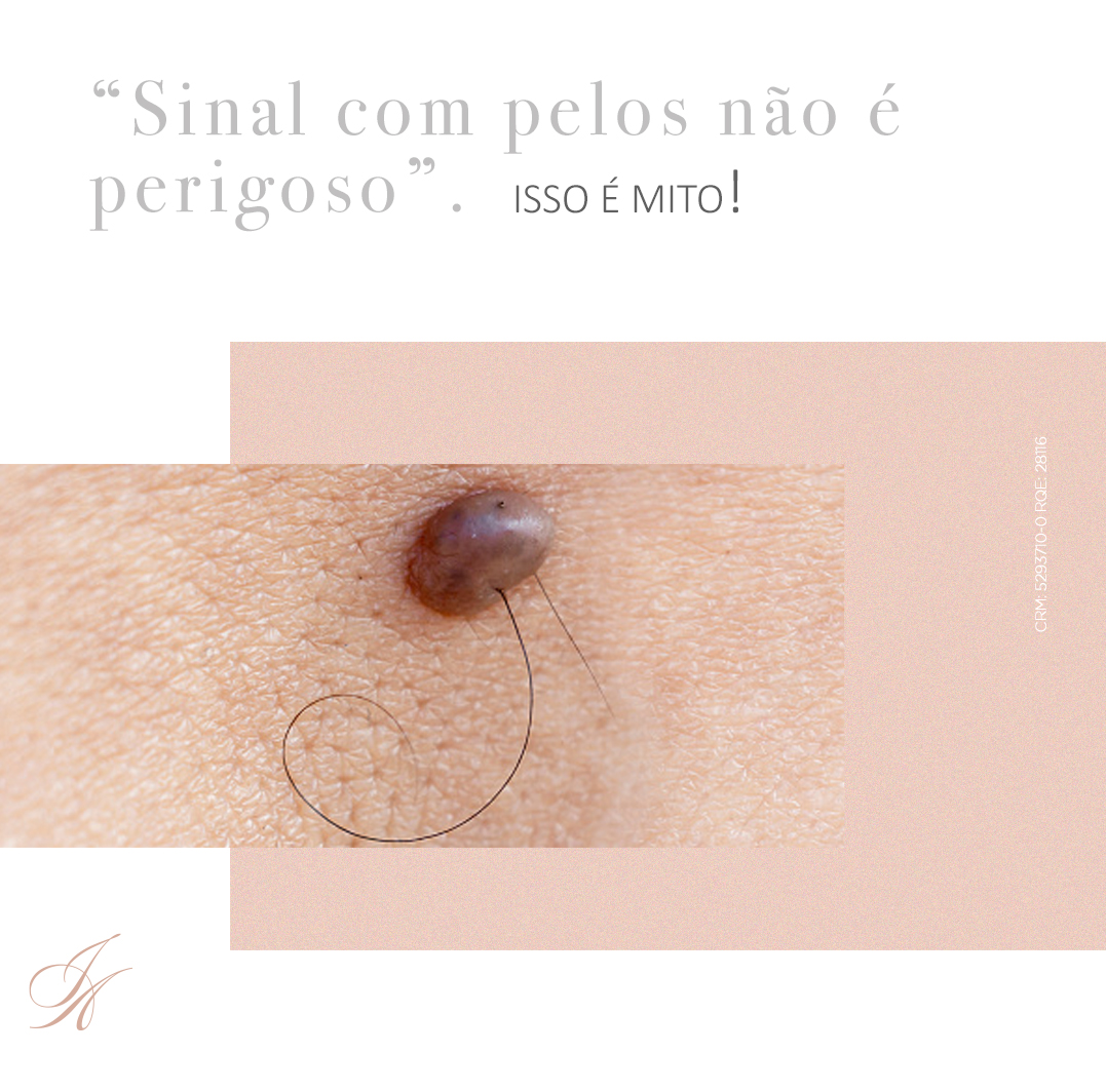 Você está visualizando atualmente “Sinal com pelos não é perigoso.” Isso é mito!