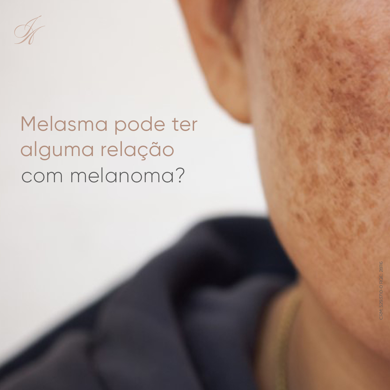 Você está visualizando atualmente Melasma pode ter alguma relação com melanoma?