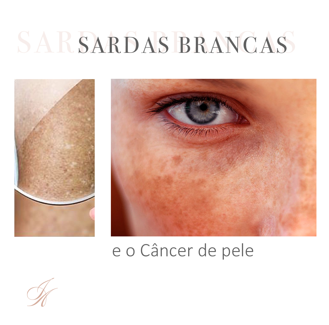 Você está visualizando atualmente Sardas brancas e o câncer de pele