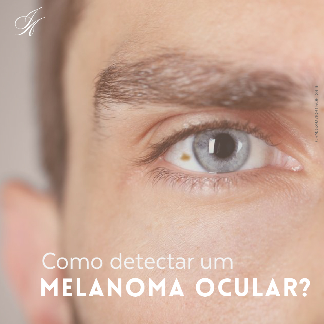 Você está visualizando atualmente Como detectar um melanoma ocular?