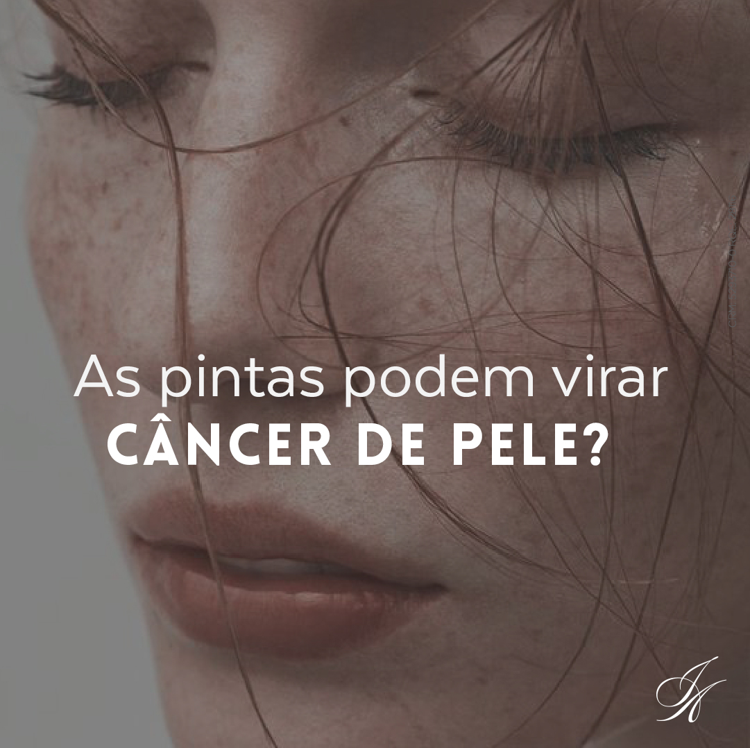 Você está visualizando atualmente As pintas podem virar câncer de pele?