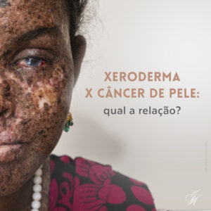 Leia mais sobre o artigo Xeroderma x câncer de pele: qual a relação?