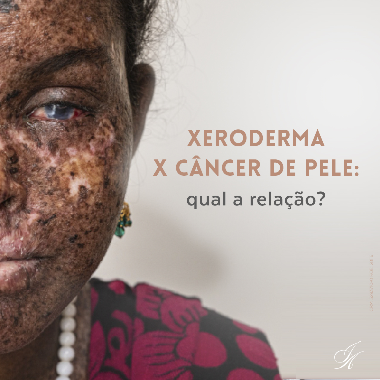 Você está visualizando atualmente Xeroderma x câncer de pele: qual a relação?