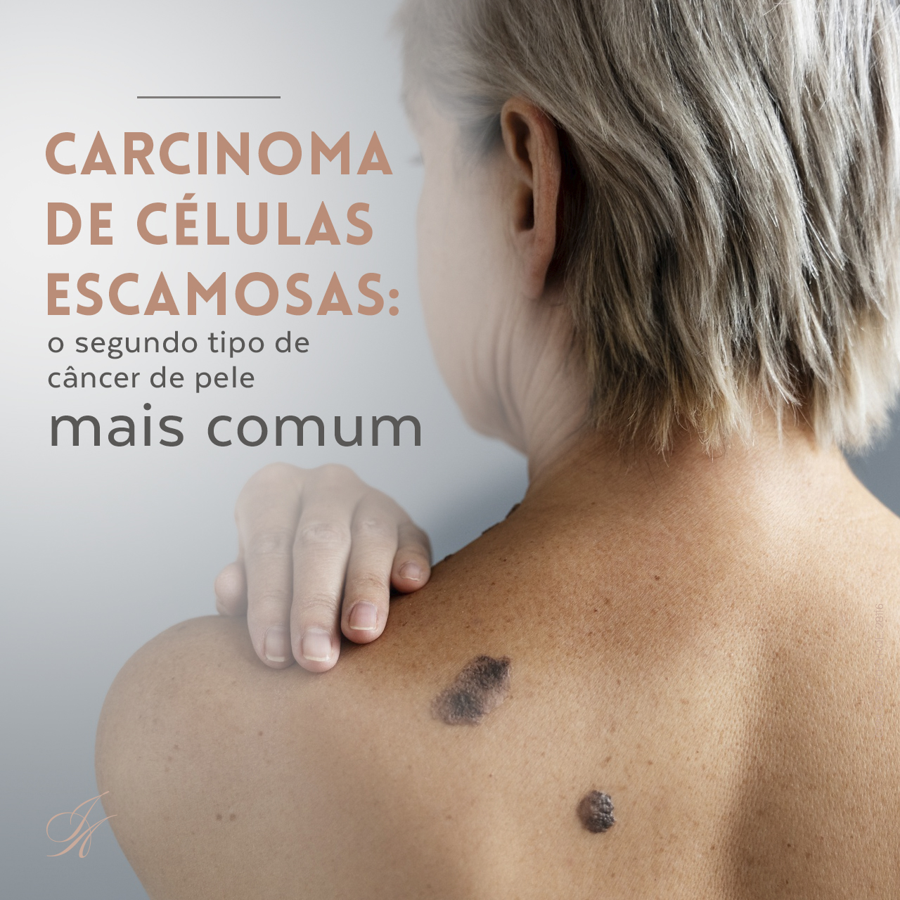 Você está visualizando atualmente Carcinoma de células escamosas: o segundo tipo de câncer de pele mais comum!