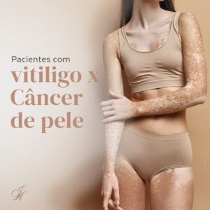 Leia mais sobre o artigo Pacientes com vitiligo x câncer de pele