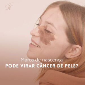 Leia mais sobre o artigo Marca de nascença pode virar câncer de pele?