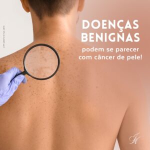 Leia mais sobre o artigo Doenças benignas podem se parecer com câncer de pele!