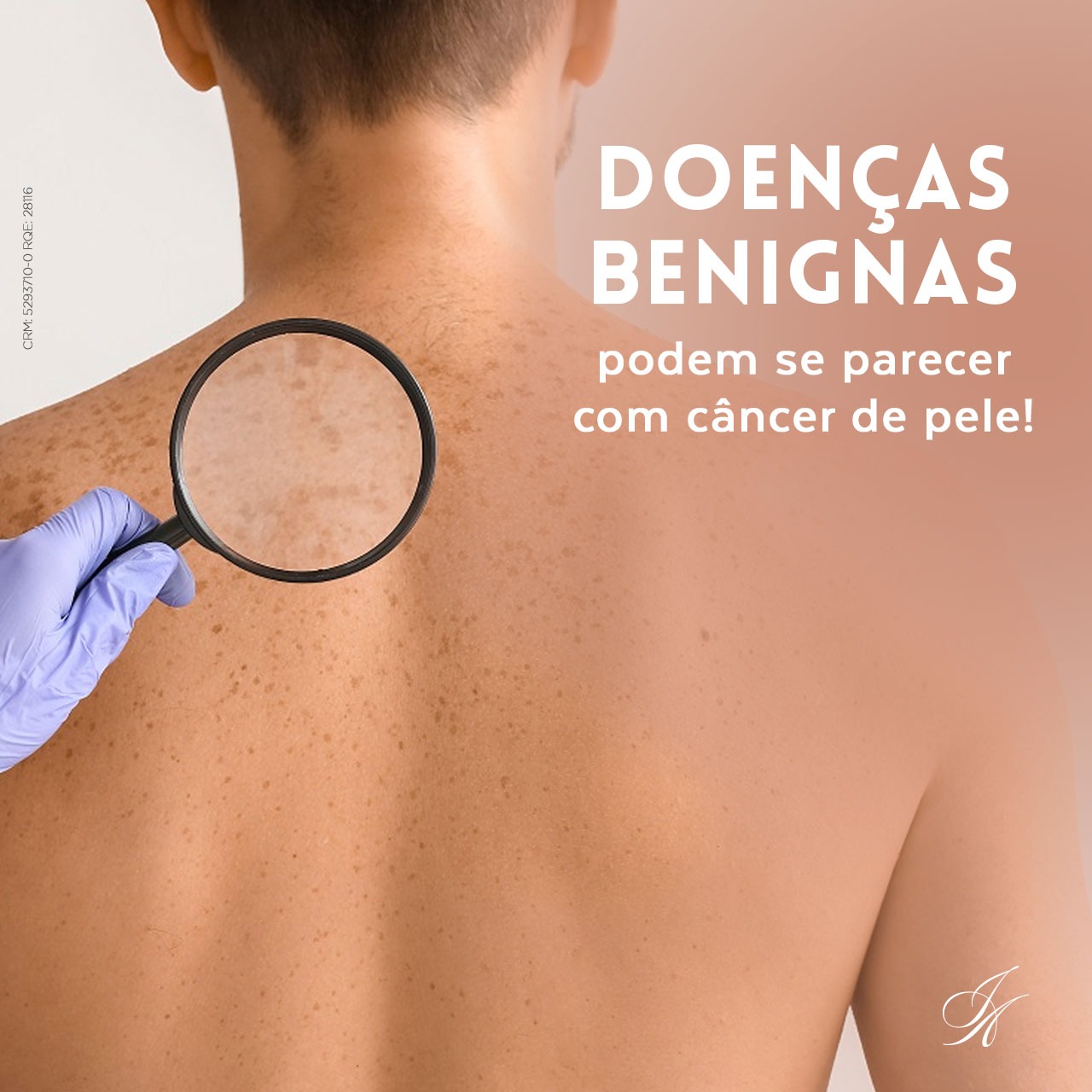 Você está visualizando atualmente Doenças benignas podem se parecer com câncer de pele!