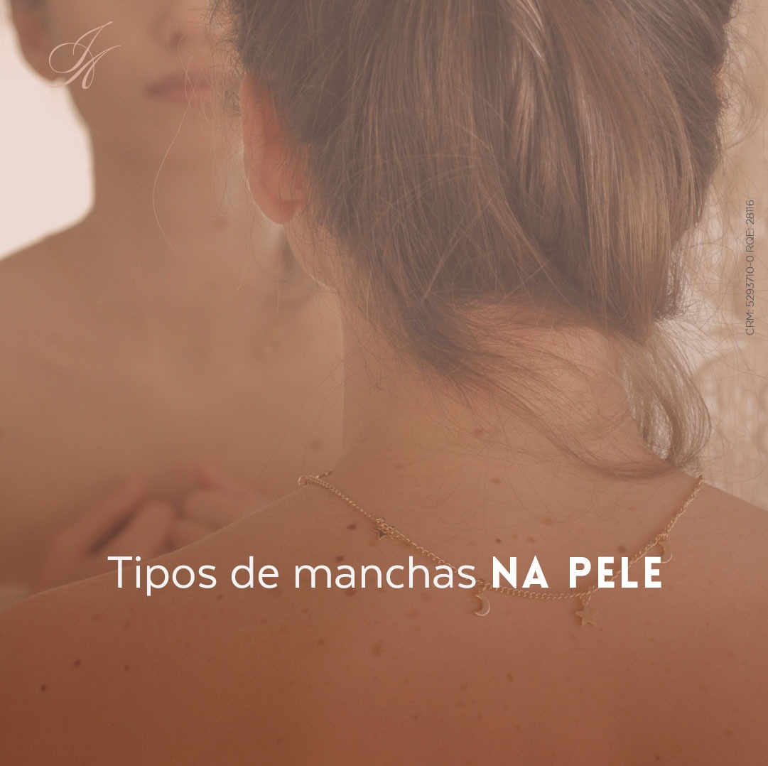 Você está visualizando atualmente Tipos de manchas na pele: