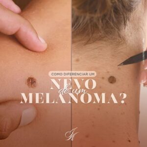 Leia mais sobre o artigo Como diferenciar um nevo de um melanoma?