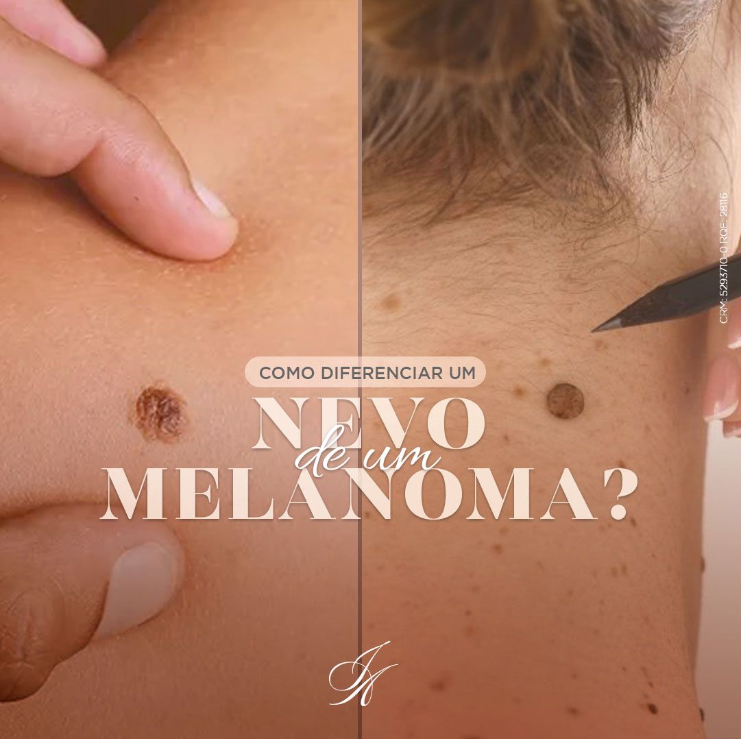 Você está visualizando atualmente Como diferenciar um nevo de um melanoma?