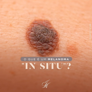 Leia mais sobre o artigo O que é um melanoma IN SITU?