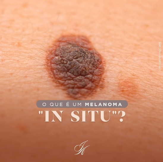 Você está visualizando atualmente O que é um melanoma IN SITU?