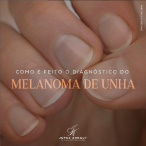 Leia mais sobre o artigo Como é feito o diagnóstico do melanoma de unha?