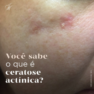 Leia mais sobre o artigo Você sabe o que é ceratose actínica?