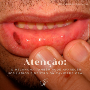 Leia mais sobre o artigo Atenção: o melanoma pode aparecer nos lábios e dentro da cavidade oral